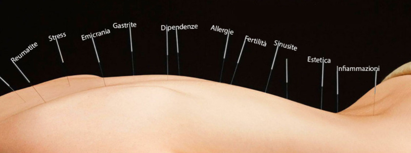 Agopuntura colon irritabile